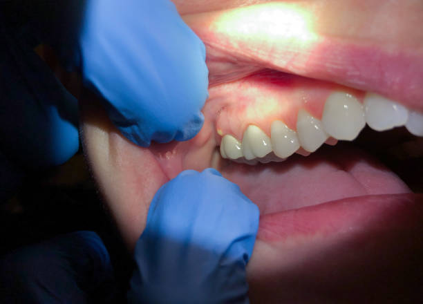 Best Emergency Denture Repair in Red Lake Falls, MN